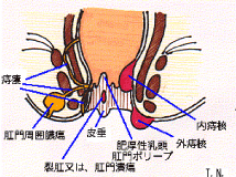 肛門疾患イラスト